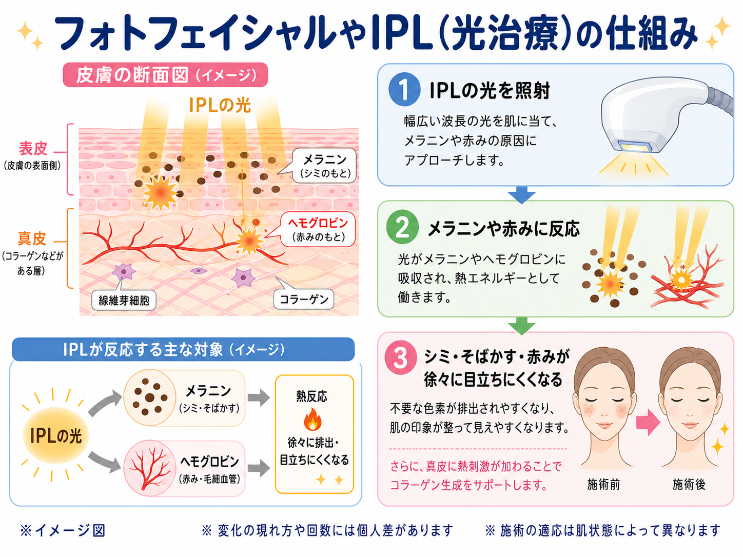 IPL（光治療）の仕組みイラスト ― 美容皮膚科ティファクリニック横浜院