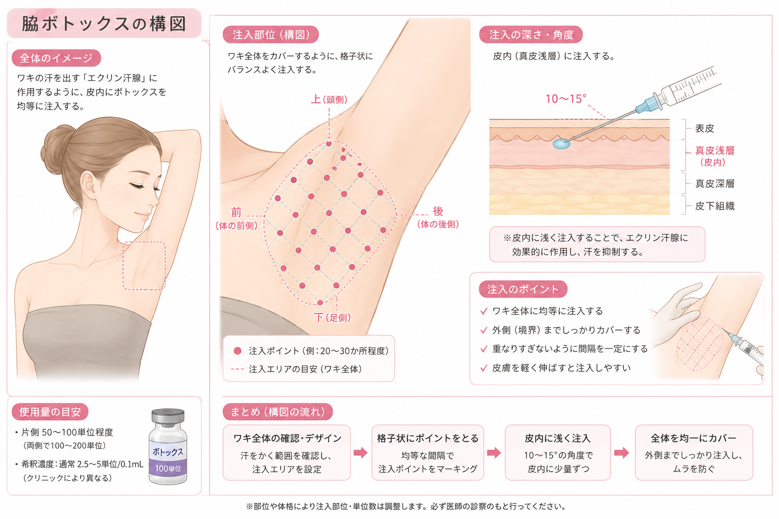 脇ボトックスの構図：注入部位・深さ・角度・ポイントを解説したインフォグラフィック