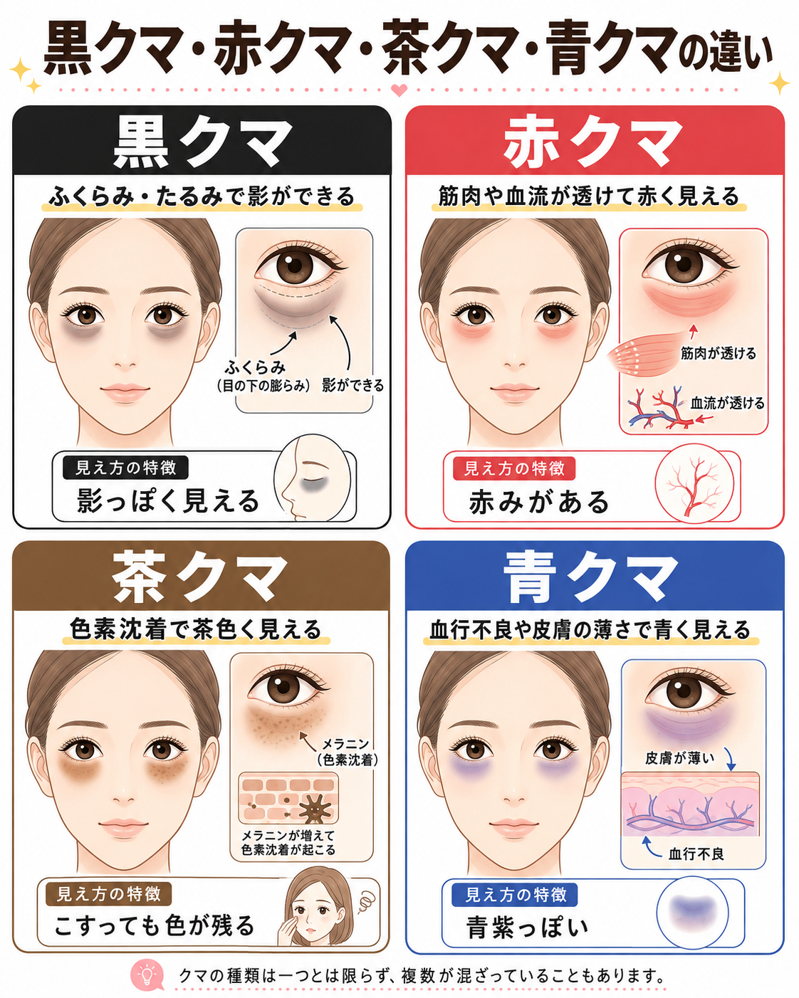 目の下のクマの種類と特徴（青クマ・茶クマ・黒クマ・赤クマ）の図解 ― 美容皮膚科ティファクリニック 横浜院