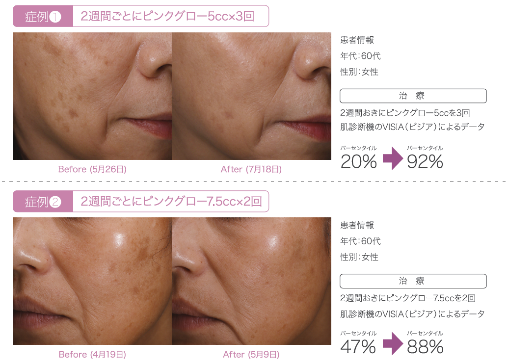 ピンクグロー症例写真（メーカー提供データ・60代女性・2週間ごとの施術例） ― 美容皮膚科ティファクリニック 横浜院
