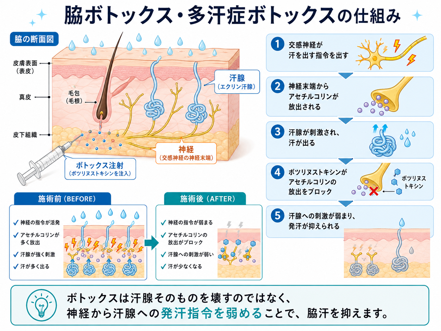 ワキ汗ボトックス（多汗症ボトックス注射）の仕組み ― 美容皮膚科ティファクリニック 横浜院