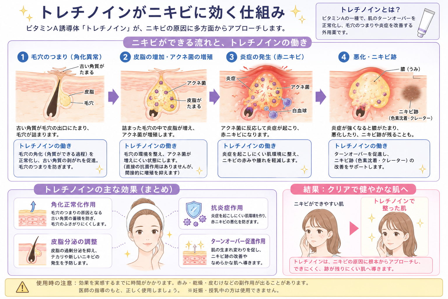 トレチノイン外用がにきびに効く仕組み｜毛穴のつまりとターンオーバーに働きかける図解