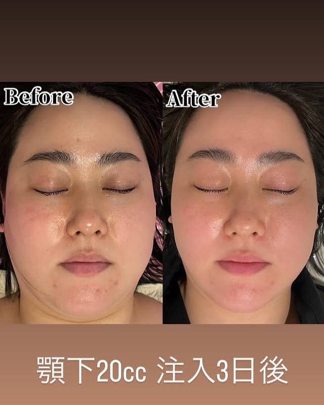 レモンボトル 顎下症例 20cc注入3日後のBefore/After ― 美容皮膚科ティファクリニック横浜院