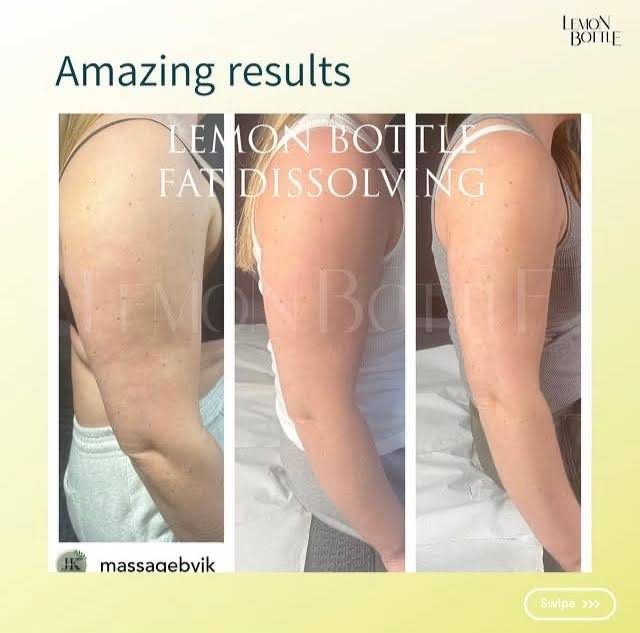 レモンボトル 二の腕症例のBefore/After ― レモンボトル 横浜