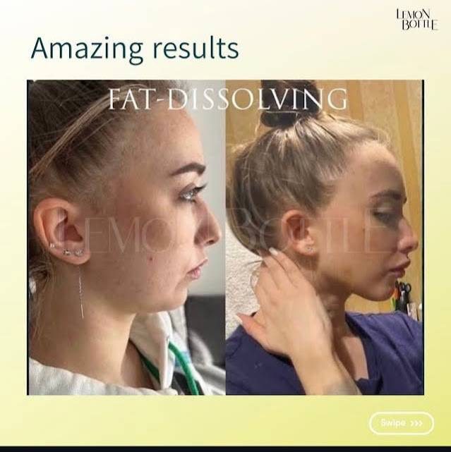 レモンボトル フェイスライン症例 横顔のBefore/After ― レモンボトル 横浜