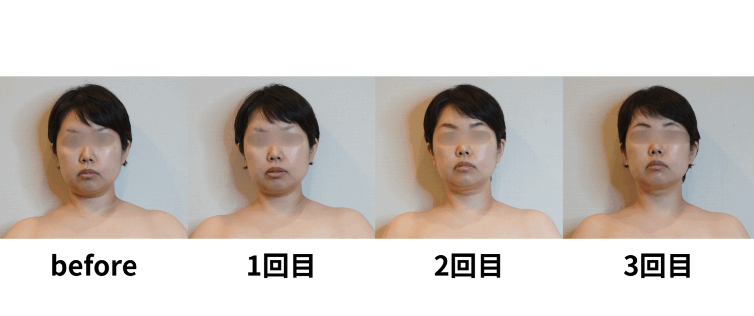 ②LDM+HIFU経過